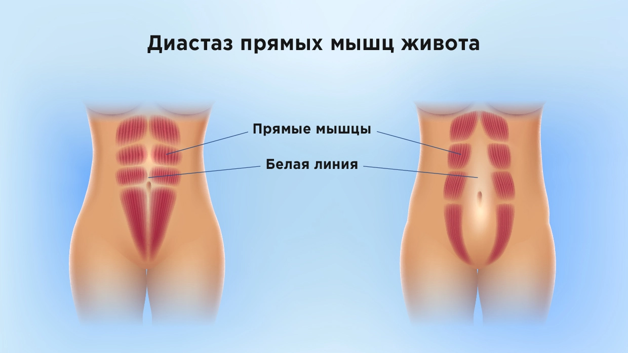 Как убрать диастаз